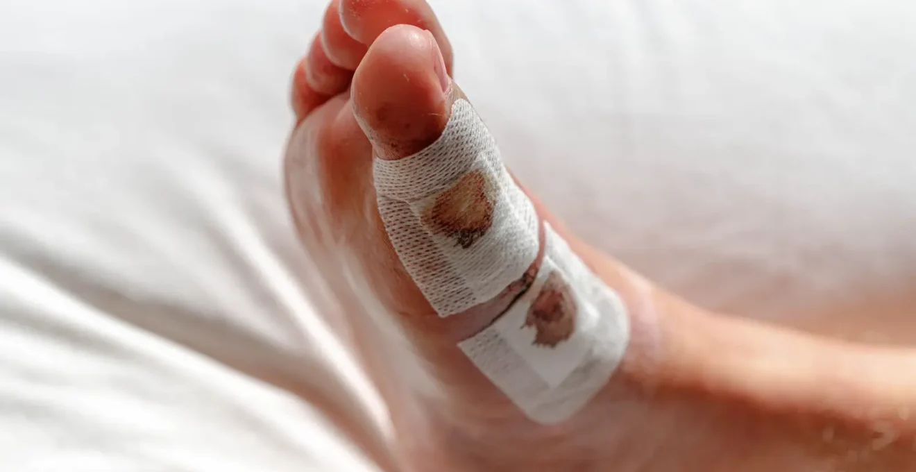Gros plan sur des mains féminines changeant un pansement stérile sur un pied bandé, avec une trousse de soins posée à côté.